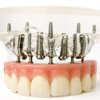 implant supported dentures